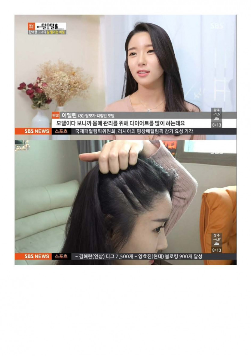 탈모가 걱정인 모델_