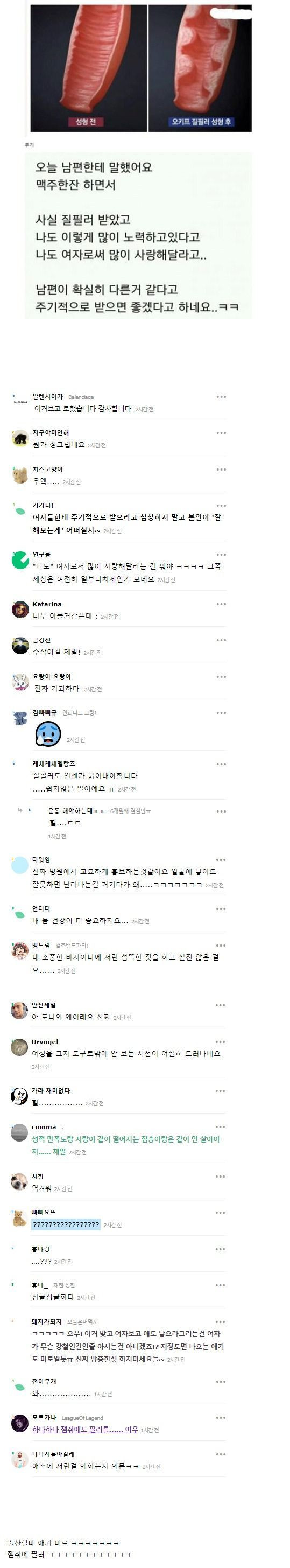 질 필러 후기를 본 여초 반응