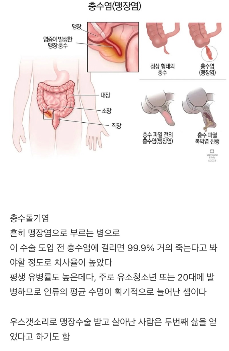 인류의 수명을 두배로 늘려준 수술