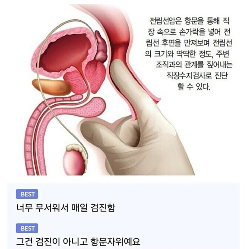 전립선암 자가진단 방법