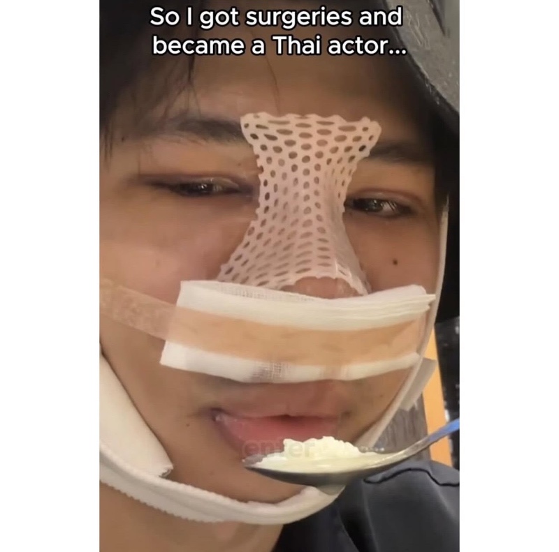 차은우 처럼 성형한 태국인 결과