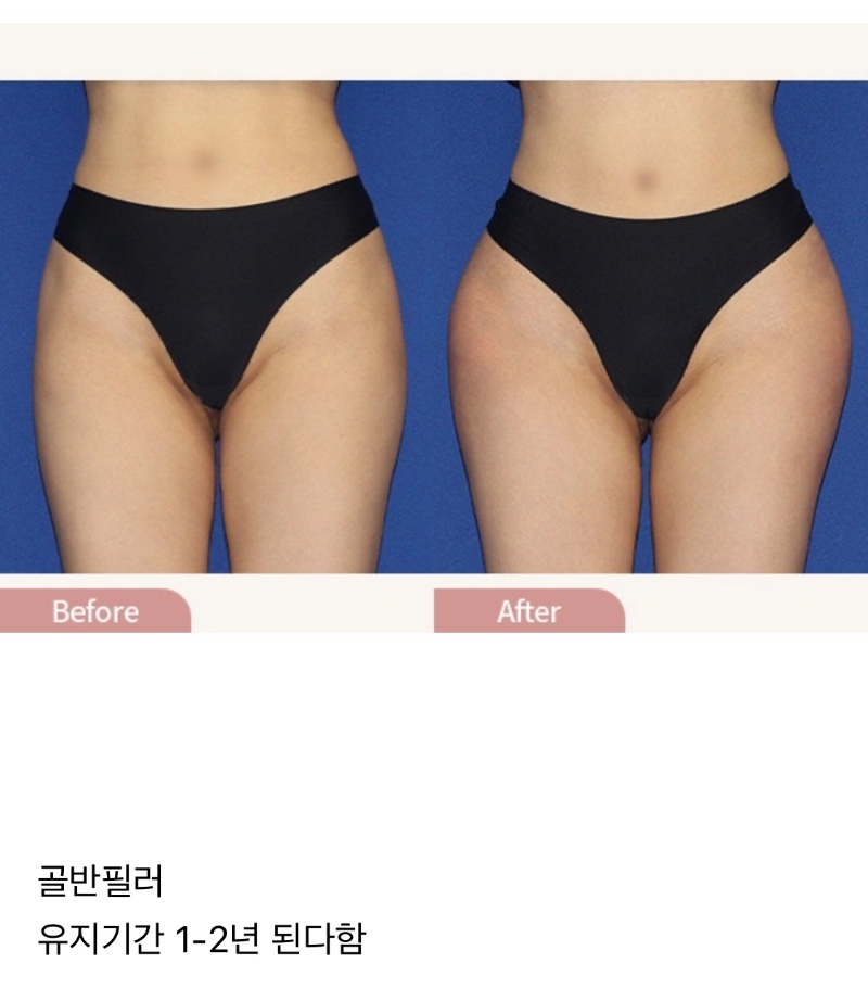요즘 은근 많이 한다는 여자 시술