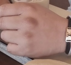 레이저시술 40회 기적