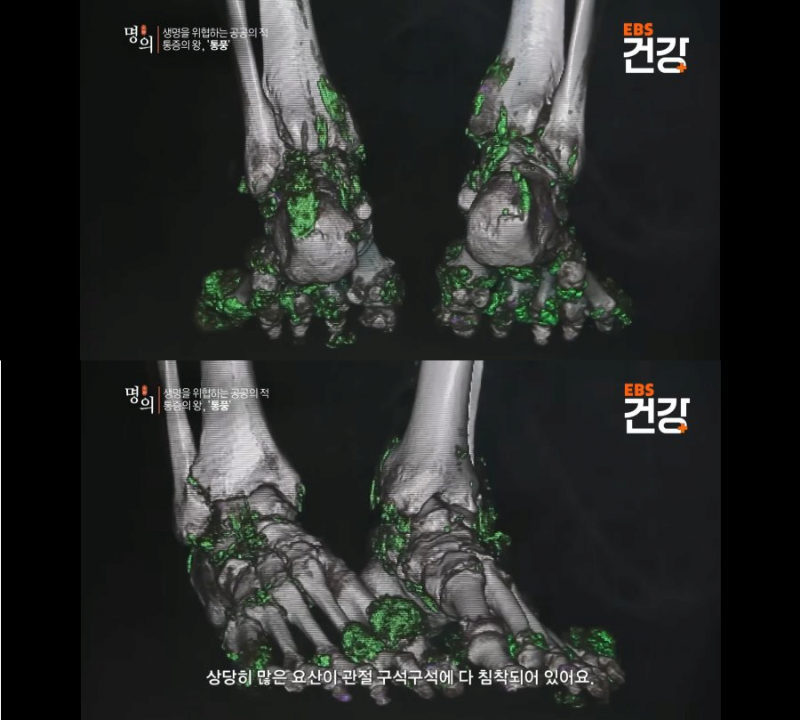통풍 환자의 발 상태